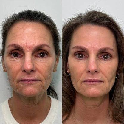 Reliefora™ Collagen Peptide Lifting Ampoule