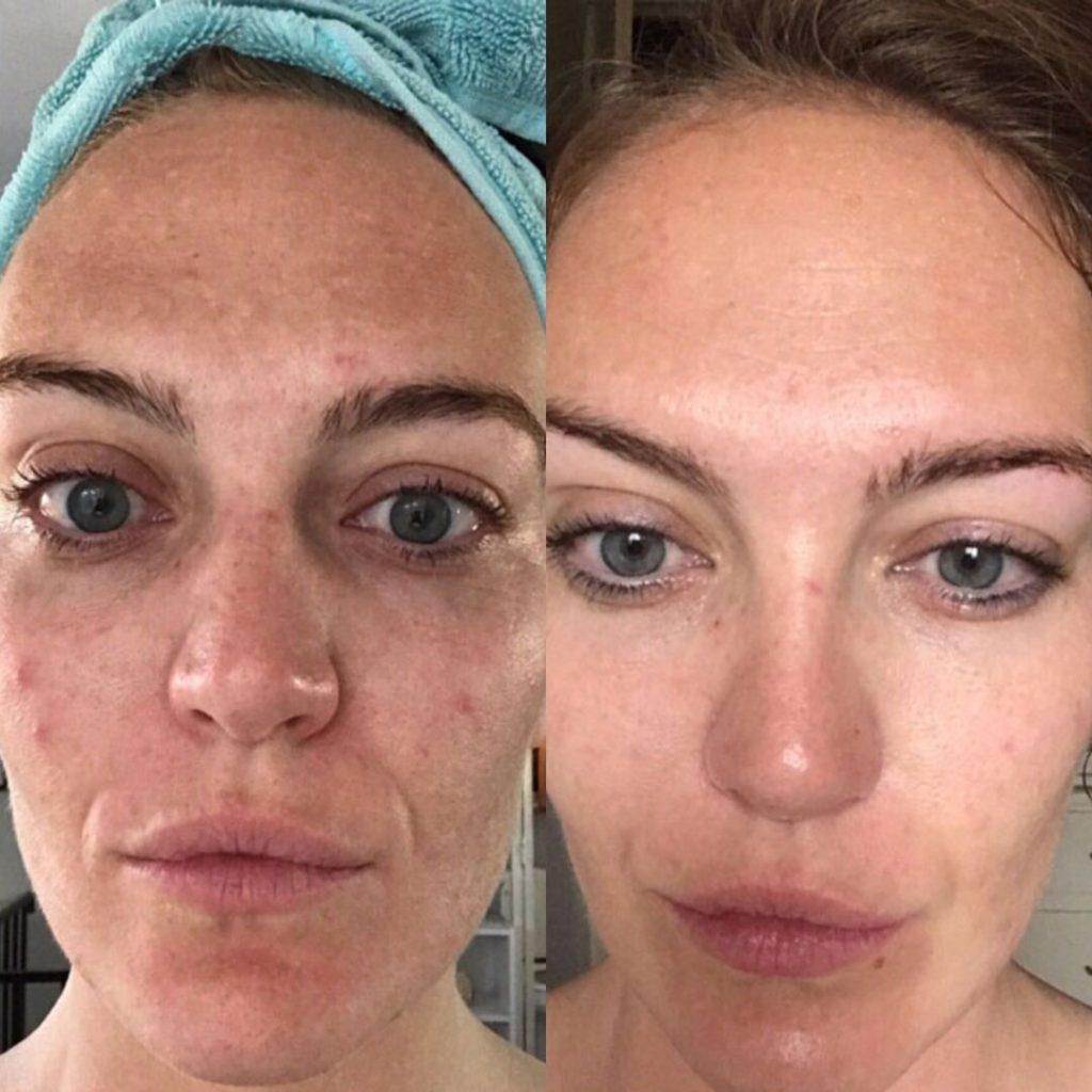 Reliefora™ Collagen Peptide Lifting Ampoule